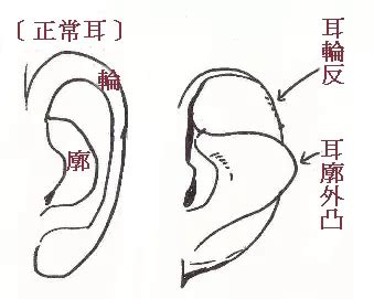 反廓耳|解析面相中的「抱頭耳」與「反廓耳」(圖) 耳朵 